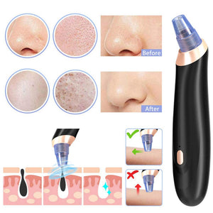 Removedor de la Espinilla, Blackhead Remover Vacuum Suction Removal tool Recargable y Ajustable Acné Extractor Juego de Herramientas de la Piel Facial Limpiador de Poros Máquina Comedón Exfoliante para la Mujer FDA Certificada